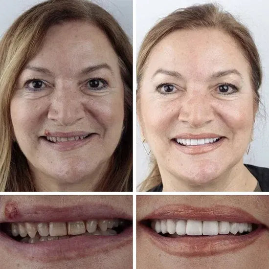 FDA-certified complete dentures (USA)